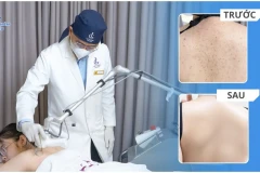 Tạm biệt da lưng sần thâm, viêm nang lông kéo dài: Vì sao nhiều khách hàng lựa chọn Phòng khám Da liễu LG?