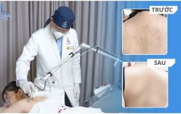 Tạm biệt da lưng sần thâm, viêm nang lông kéo dài: Vì sao nhiều khách hàng lựa chọn Phòng khám Da liễu LG?