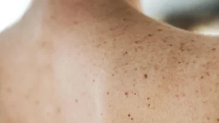 Moderna công bố kết quả tích cực từ vaccine mRNA chống ung thư da