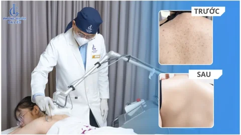 Tạm biệt da lưng sần thâm, viêm nang lông kéo dài: Vì sao nhiều khách hàng lựa chọn Phòng khám Da liễu LG?