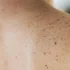 Moderna công bố kết quả tích cực từ vaccine mRNA chống ung thư da
